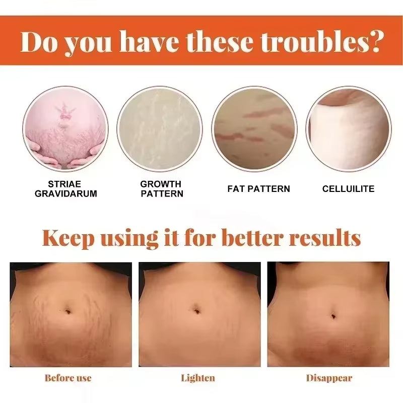 Stretch Mark Vanishing Cream Remove Body Buttock Breast Marks Effective Repair Maternity Loose Firming Skin Care