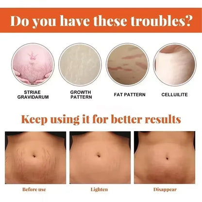Stretch Mark Vanishing Cream Remove Body Buttock Breast Marks Effective Repair Maternity Loose Firming Skin Care